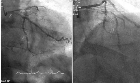 Can thiệp kịp thời cứu cụ ông 86 tuổi sốc tim nguy kịch