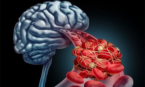 Dị dạng mạch máu: Dấu hiệu nhận biết và mức độ nguy hiểm không thể chủ quan