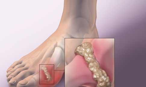 Người bệnh gout khổ sở với tiệc tùng cuối năm