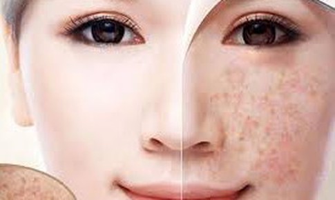 Nhận diện thủ phạm gây đốm đồi mồi trên da