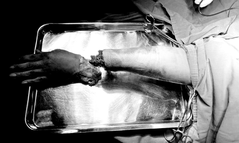 Nỗ lực giữ lại bàn tay công nhân bị dập nát do tai nạn lao động