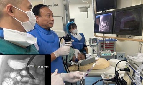 Sỏi ống mật chủ 'khủng' gây tắc mật nặng