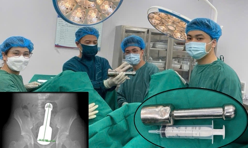 Thiếu niên 15 tuổi cấp cứu vì chiếc chày 18cm mắc kẹt hậu môn