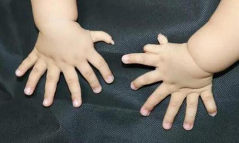 Vì sao nên điều trị sớm dị tật thừa ngón tay ở trẻ?