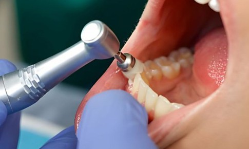 Nên lấy cao răng bao lâu một lần?