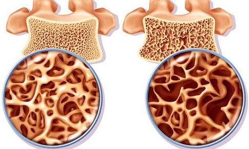 4 bí quyết giúp người lớn tuổi giảm nguy cơ loãng xương
