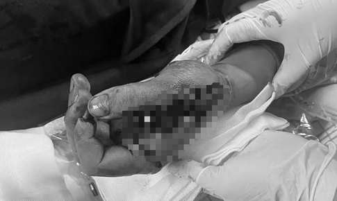 Tai nạn trong tích tắc vì pháo nổ, nam thanh niên suýt mất chức năng bàn tay