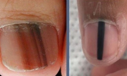 Sọc sẫm màu trên móng tay, móng chân là biểu hiện của bệnh gì?