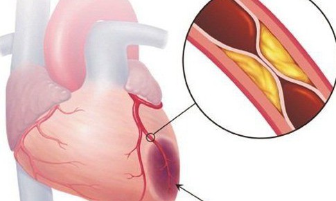 Dùng thuốc đúng cách giúp kiểm soát mỡ máu cao, phòng ngừa biến chứng tim mạch