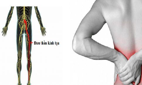 Vitamin và khoáng chất nào tốt cho người đau thần kinh tọa?