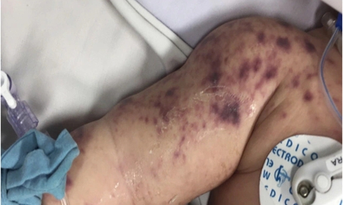 Sở Y tế An Giang xác nhận trẻ tử vong ở Phú Quốc do viêm não mô cầu