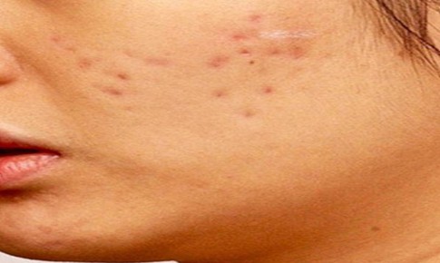 Sẹo rỗ có tự làm đầy được không?