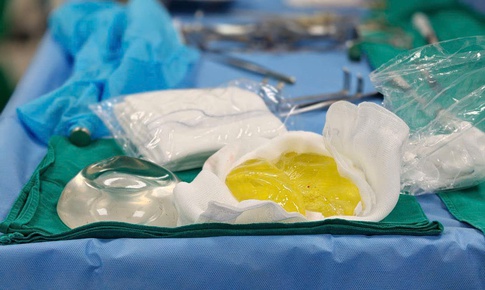 Người phụ nữ tá hoả vì túi ngực vỡ vụn sau 5 năm dù không có cảm giác đau