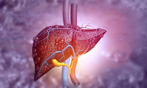 4 giải pháp trị gan nhiễm mỡ không dùng thuốc