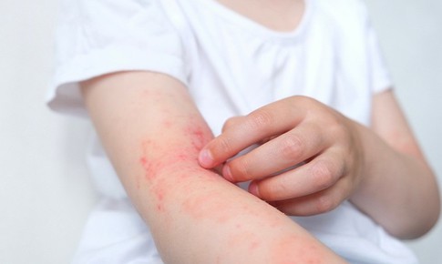 Cách chọn kem dưỡng ẩm trong liệu trình điều trị viêm da dị ứng tốt nhất