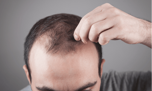 5 loại dầu dưỡng tự nhiên tốt nhất cho nam giới bị hói đầu