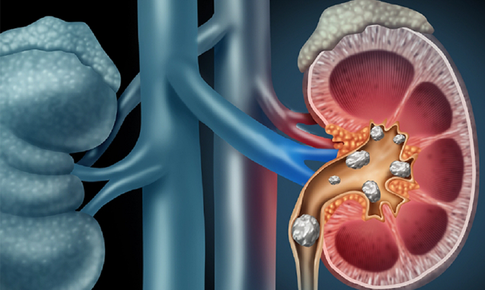 Sỏi san hô nguy hiểm nhận biết ra sao?