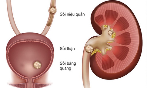 5 nguyên nhân làm tăng nguy cơ sỏi niệu quản và cách phòng ngừa hiệu quả