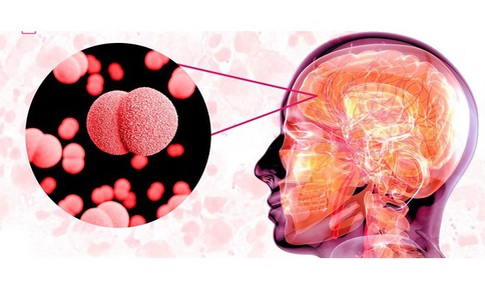 Viêm não mô cầu lây truyền như thế nào và dấu hiệu nhận biết đặc trưng