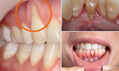 Tụt lợi có thực sự nguy hiểm?