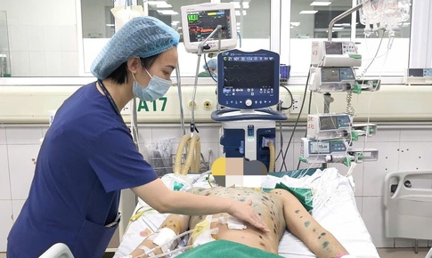 Nhiều người lớn mắc thủy đậu biến chứng nguy kịch