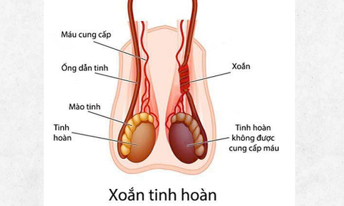 Nam sinh 14 tuổi phải cắt bỏ tinh hoàn do nhập viện muộn
