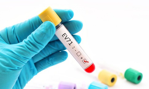 Trẻ mắc tay chân miệng do virus EV71 dễ chuyển nặng: khả năng tồn tại và lây lan của virus là bao lâu?