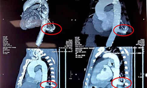 Bệnh viện Bình Dân phẫu thuật robot cắt phổi biệt lập, xử trí dị tật hiếm gặp trong lồng ngực