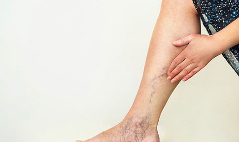 Yếu tố nguy cơ không nên xem nhẹ của suy tĩnh mạch chi dưới