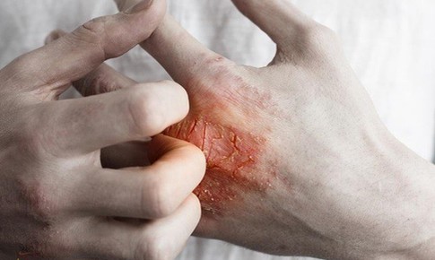 Bí quyết kiểm soát và phòng ngừa eczema hiệu quả
