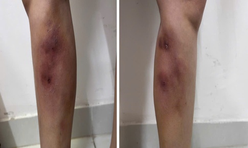 Cẳng chân người phụ nữ 29 tuổi biến dạng vì tiêm filler để làm... thẳng chân tại nhà