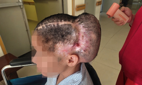 Đột quỵ sau cấy mỡ tự thân, nữ bệnh nhân phải tái tạo hộp sọ