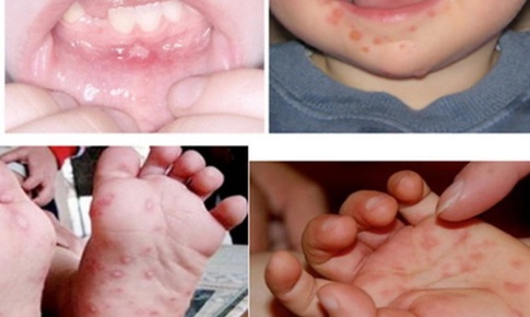 Số ca mắc tay chân miệng tăng cao, Lâm Đồng siết chặt phòng chống dịch