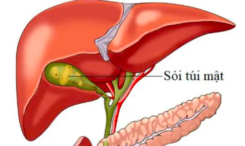 Dấu hiệu cảnh báo sỏi túi mật, nhận biết sớm để tránh biến chứng nguy hiểm