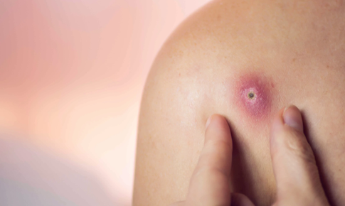 Thực phẩm giúp cải thiện tình trạng mụn nhọt trên da