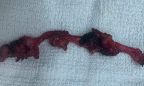 Đau âm ỉ vùng bụng, phát hiện bệnh hiếm nằm sát bàng quang