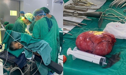 Phẫu thuật thành công khối u sau phúc mạc khổng lồ nằm ở vị trí phức tạp