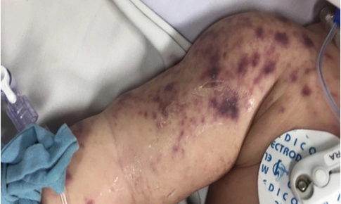 Đã có 4 ca tử vong do não mô cầu, cần biết 4 khuyến cáo phòng bệnh của Bộ Y tế