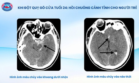 Bệnh viện Hữu nghị Việt Tiệp cứu sống bệnh nhân 24 tuổi bị đột quỵ