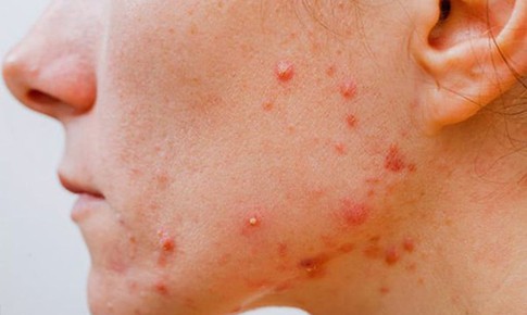 7 yếu tố dẫn đến tình trạng mụn viêm trên da
