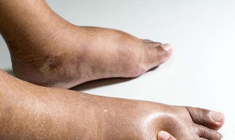 Chân voi là bệnh gì, có nguy hiểm không?