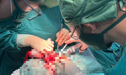 Cắt bỏ khối u giáp khổng lồ nằm sát mạch máu lớn và dây thần kinh 