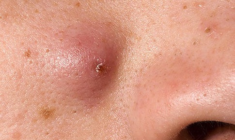 Có nên nặn mụn nhọt ở mặt không? những sai lầm dễ gây biến chứng