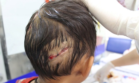 Bé 4 tuổi bị chó nhà cắn, nhiều vết thương nặng ở đầu và tay