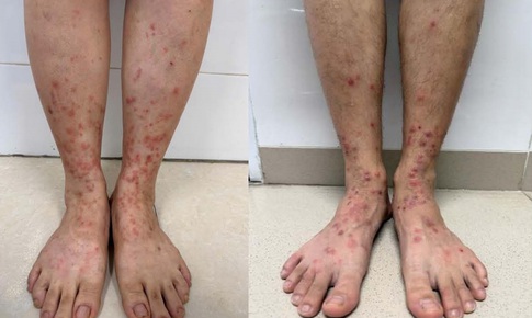 Viêm da do bọ chét: Dấu hiệu nhận biết sớm và cách xử lý tránh nhiễm trùng