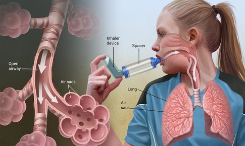Triệu chứng thường gặp và các mức độ khó thở ở hen suyễn