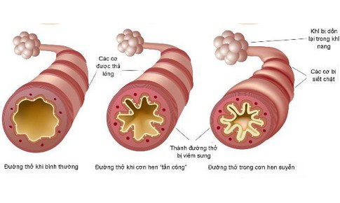 Bệnh hen có lây không?