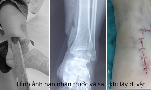 Một phụ nữ bị dị vật cắm sâu vào cẳng chân sau tai nạn giao thông