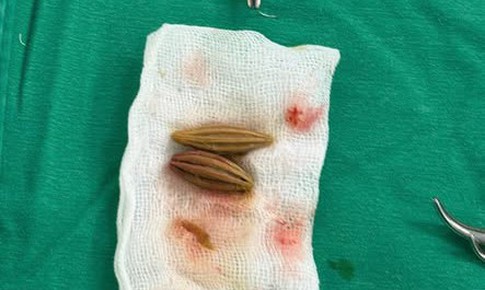 Cụ bà cao tuổi thủng trực tràng vì nuốt hạt nhót