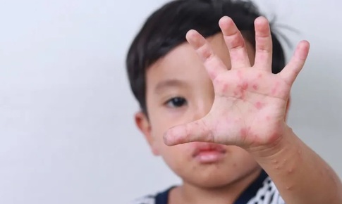 Vì sao bệnh tay chân miệng tăng mạnh ở trẻ mầm non vào đầu tuần?